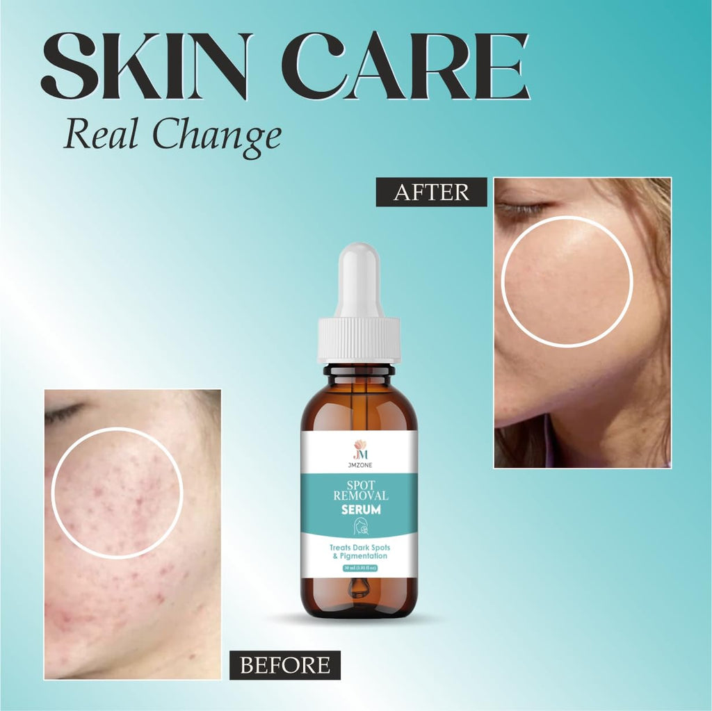 JMZONE Spot Removal Serum, Treats Dark Spots & Pigmentation, 30 ml